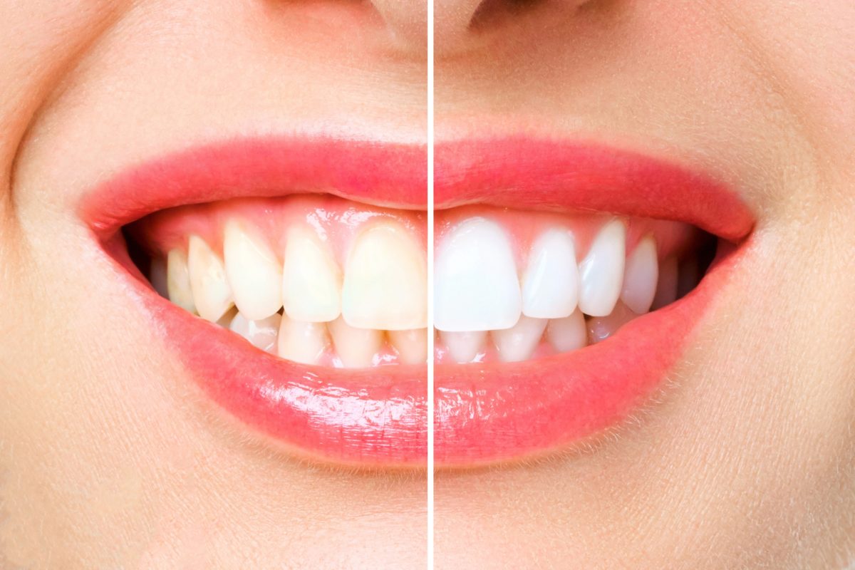 Whitening your teeth