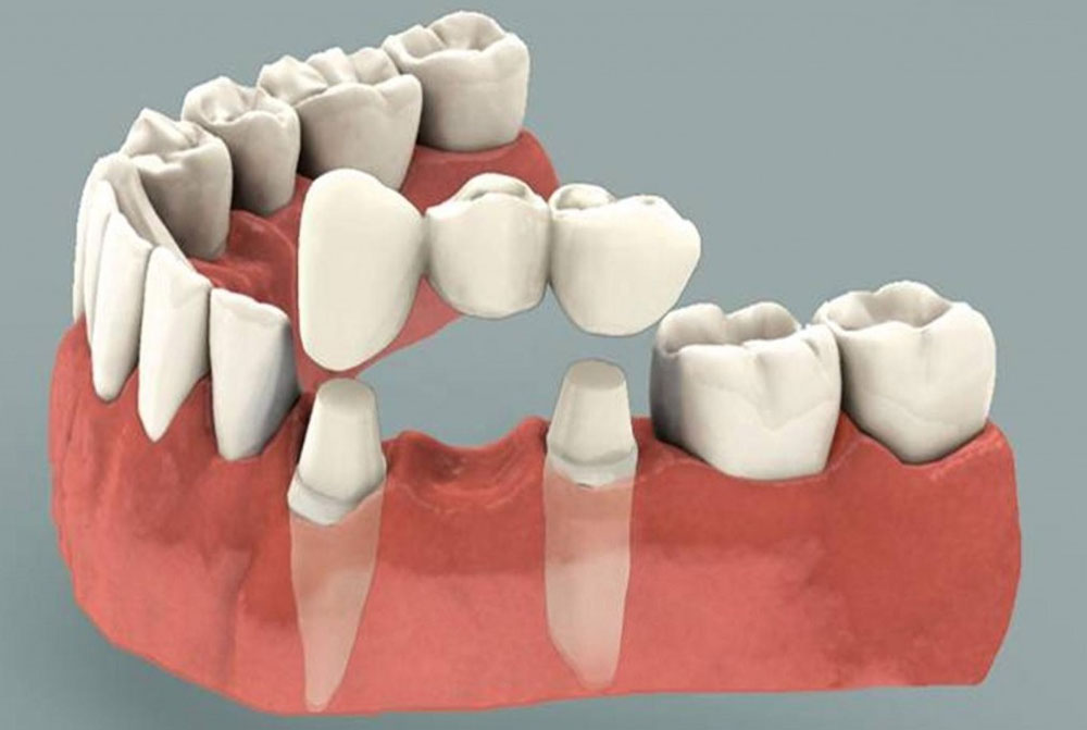 Crowns and Bridges<br />
